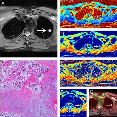 A comparison study of monoexponential and fractional order calculus diffusion models and 18F-FDG PET in differentiating benign and malignant solitary pulmonary lesions and their pathological types